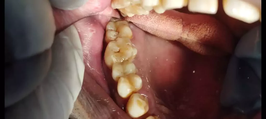 After-Cosmetic-Filling-1-1024x461
