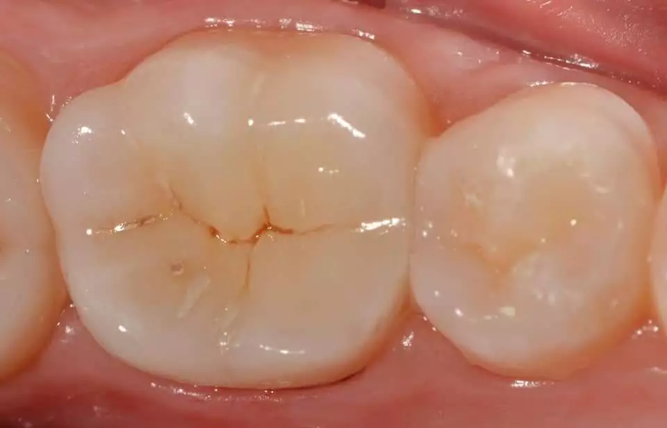 After-Filling-restoration