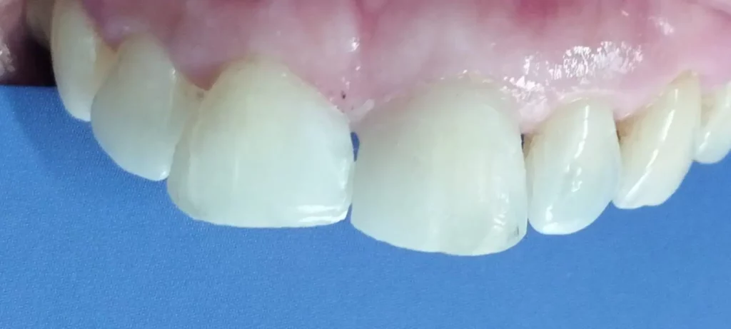 After-Median-Diastema-Restoration-e1674449554423-1024x461