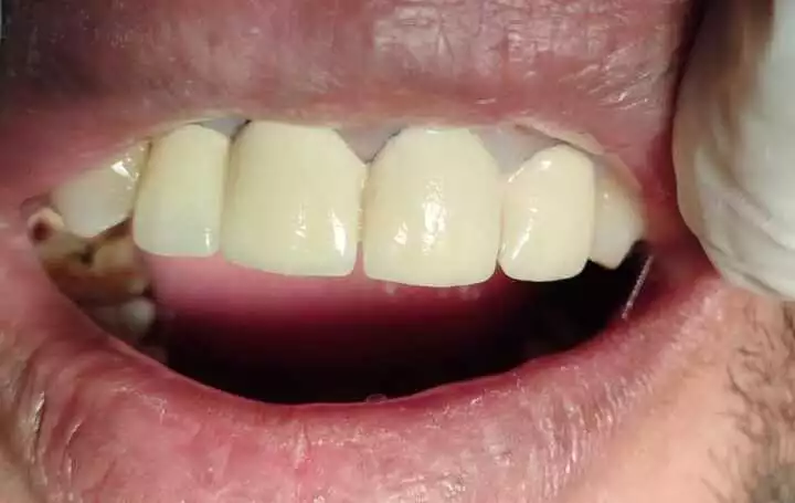 After-Root-Canal-Treatment