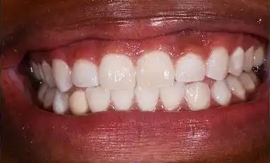 After tooth-whitening