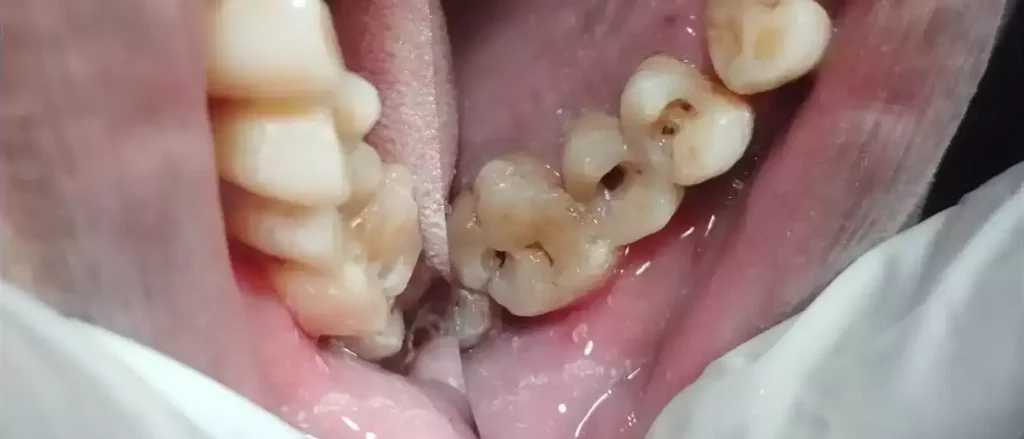 Before-Cosmetic-Filling-1-1024x439