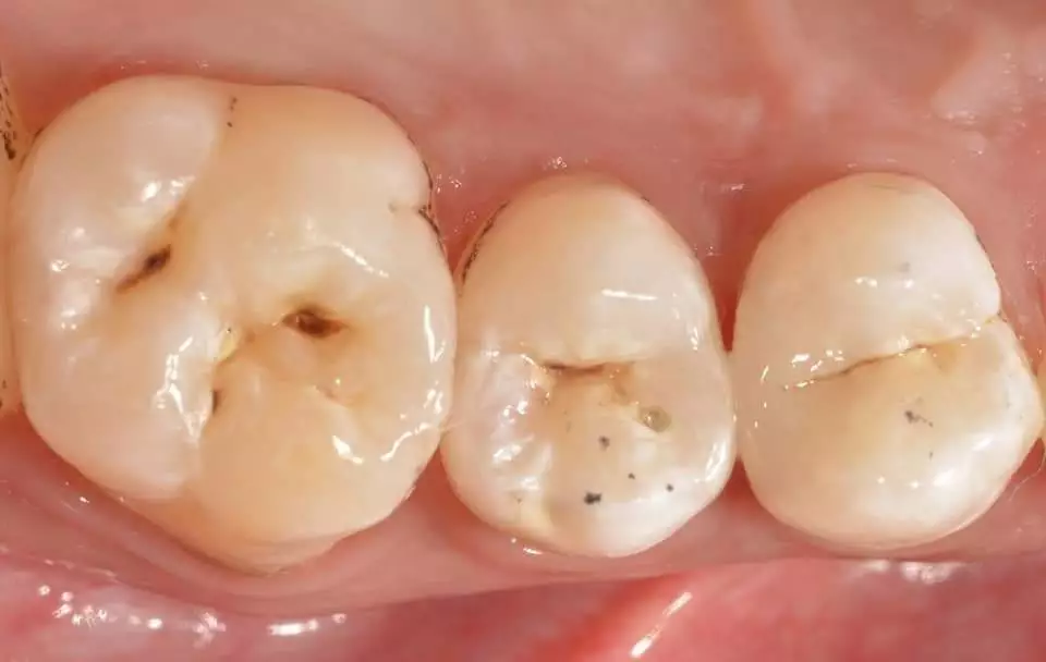 Before-Cosmetic-filling-2