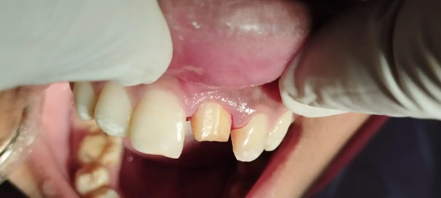 Before Root Canal (RCT) & Crown Treatment