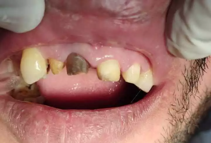 Before-Root-Canal-Treatment