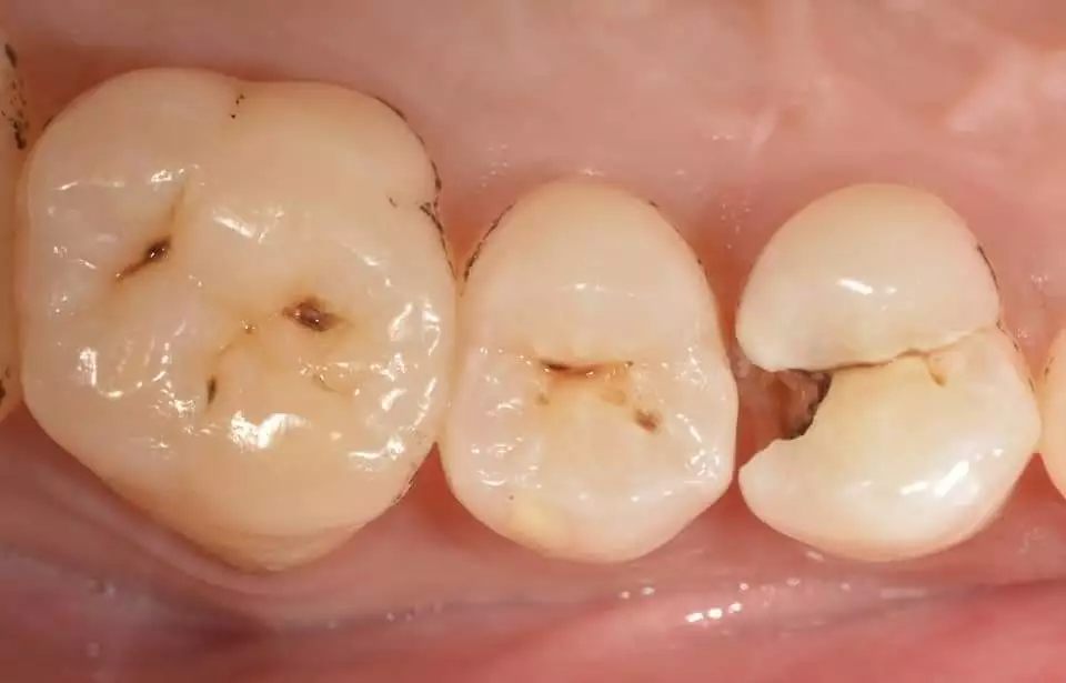 Before-filling