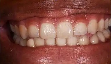 Before tooth-whitening