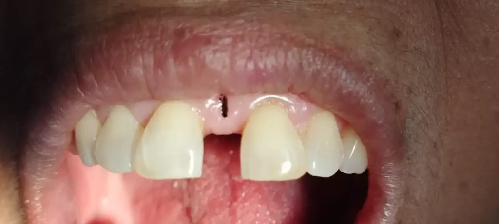 Median-Diastema-Restoration-e1674449483637-1024x461